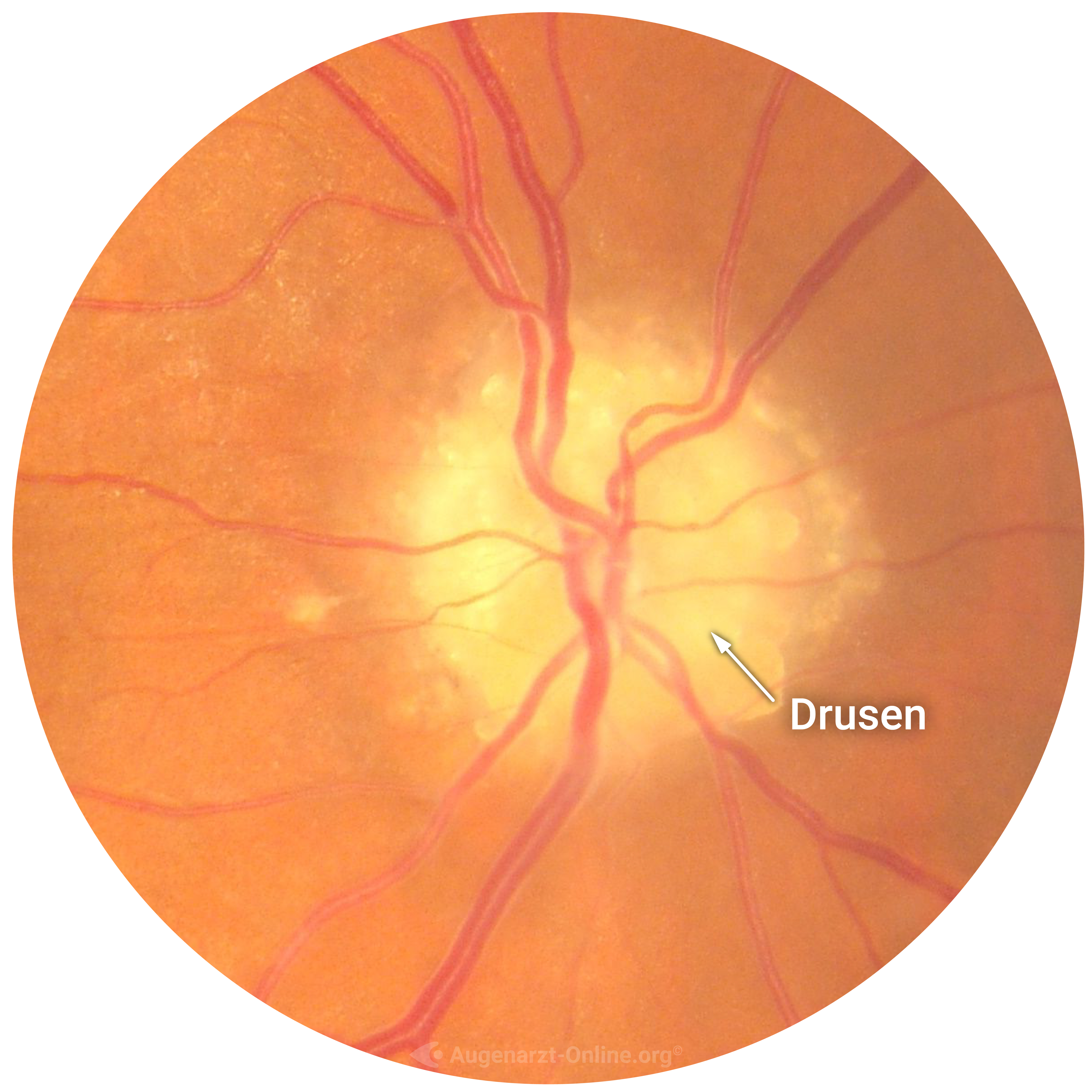 011b-Fundus Trainer Ophtalmoscopy Examination-Optic Nerve-Drusen Papille optic disc drusen.jpg