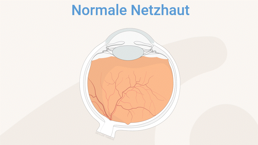 Erklärung Animation-Chorioretinopathia Centralis Serosa.gif