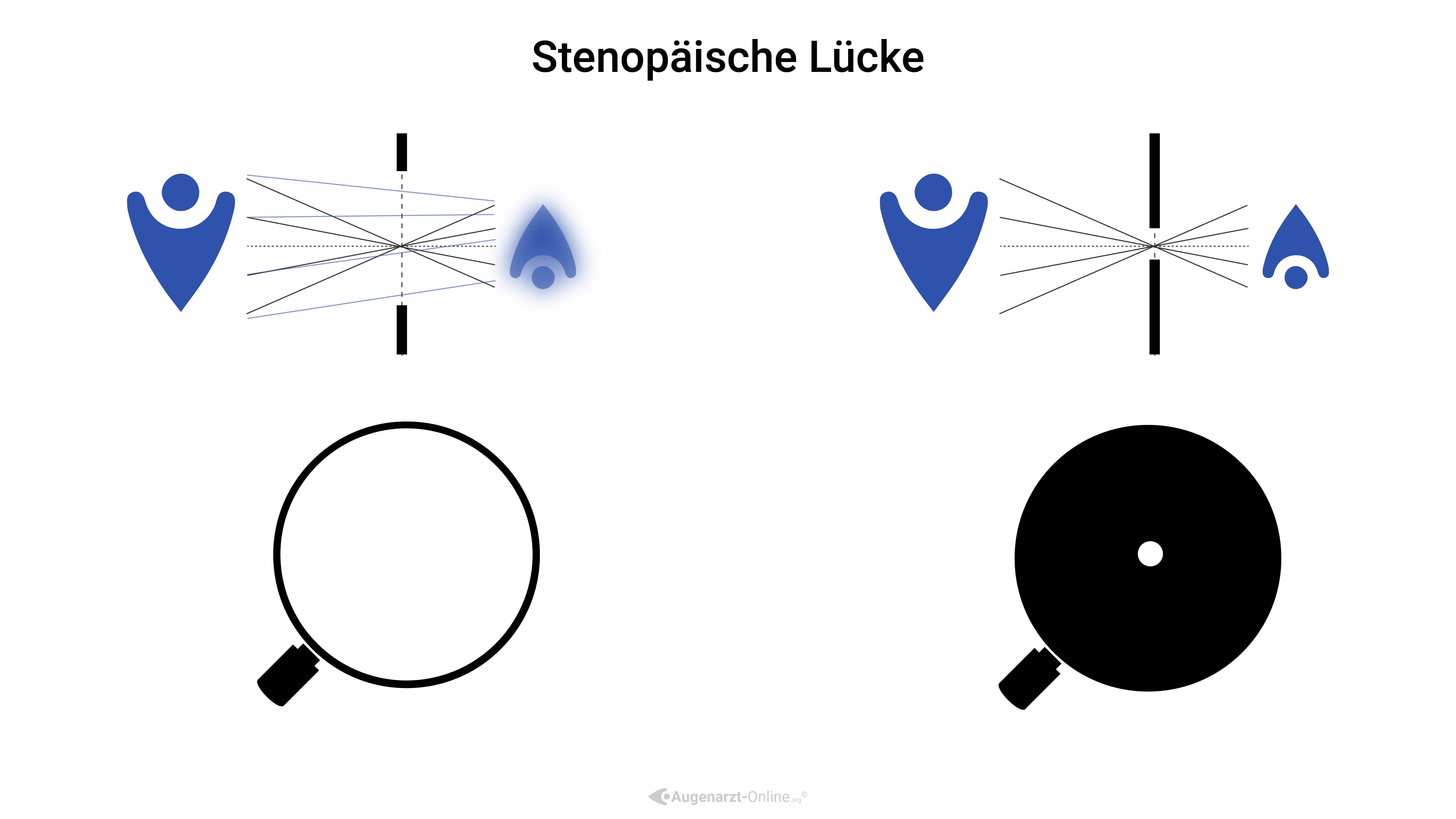Funktion einer stenopäischen Lücke