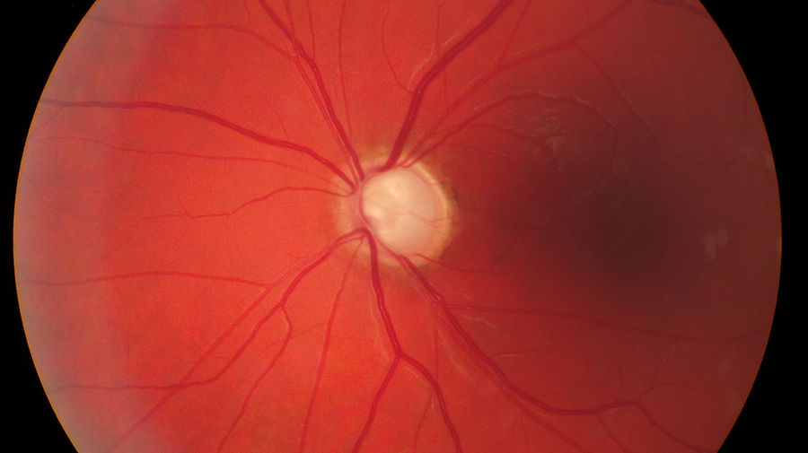 Fundusfoto-Darstellung von Glaukomatös exkavierte Papille am linken Auge. Augenhintergrund bei Grünem Star mit zunehmender Papillenexkavation.