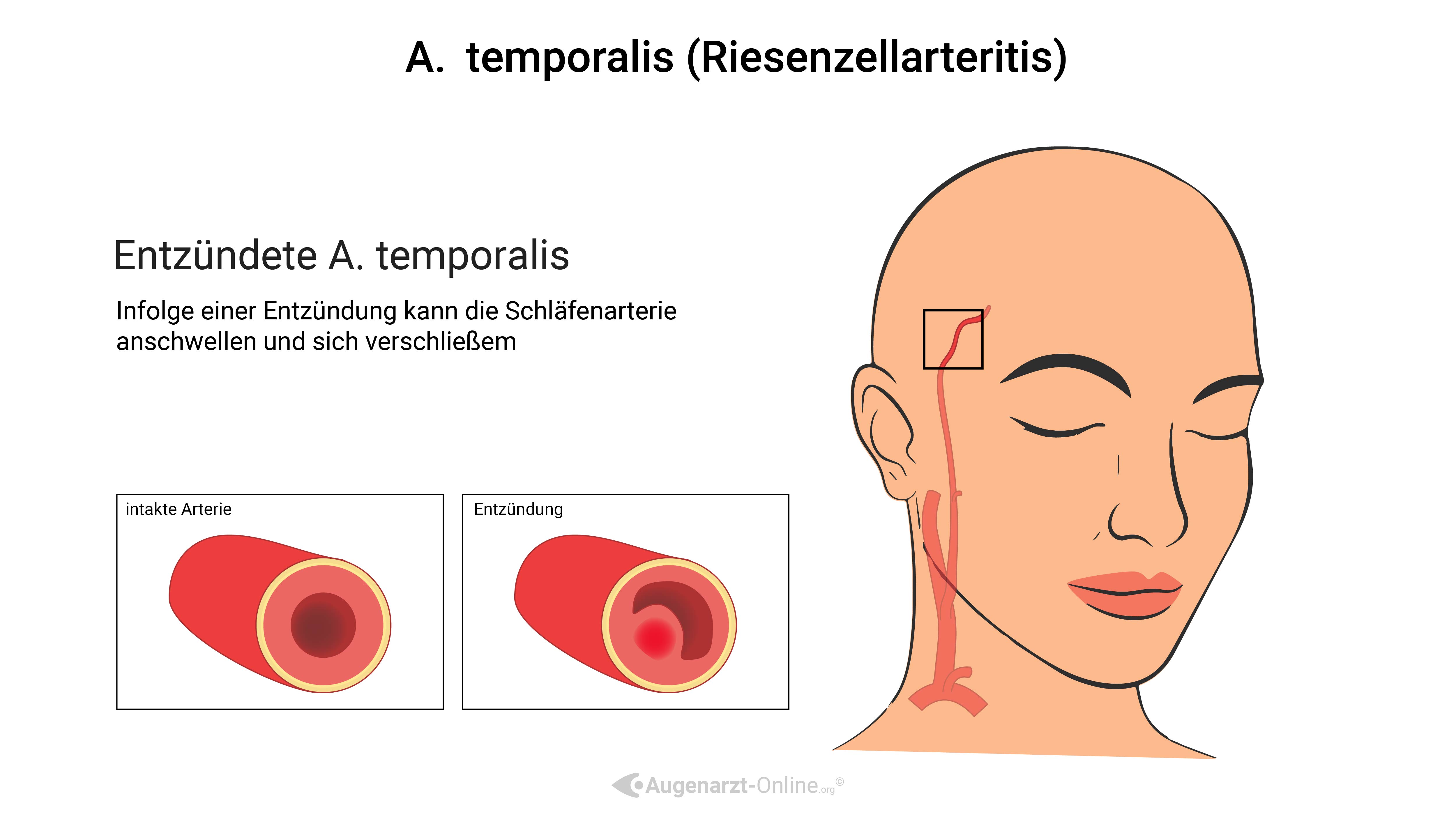 Arteriitis temporalis (Riesenzellarteritis)