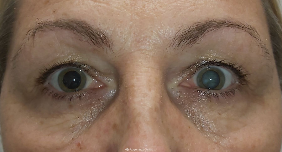 Fortgeschrittener Grauer Star am linken Auge einer Patientin.