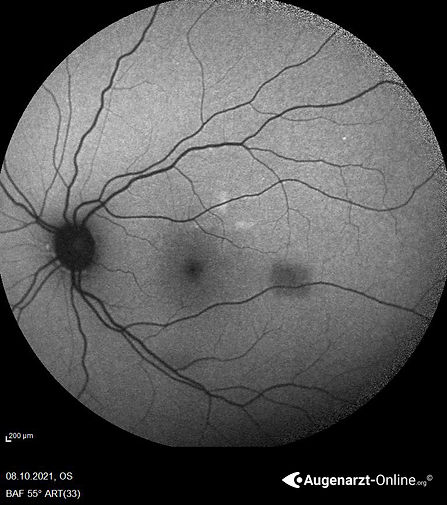 Autofluoreszenzaufnahme der Läsion