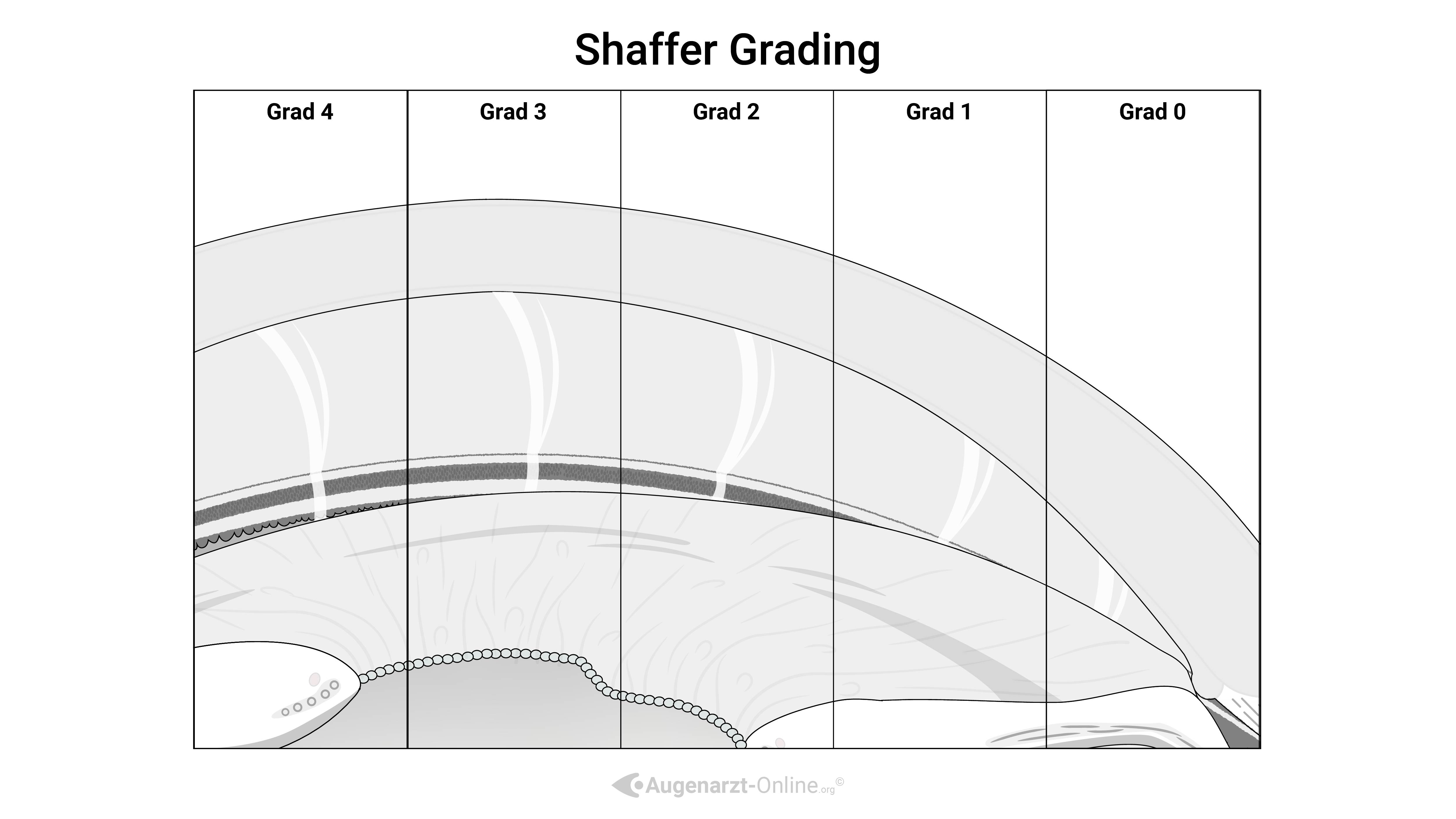 Kammerwinkelbeurteilung Shaffer Klassifikation
