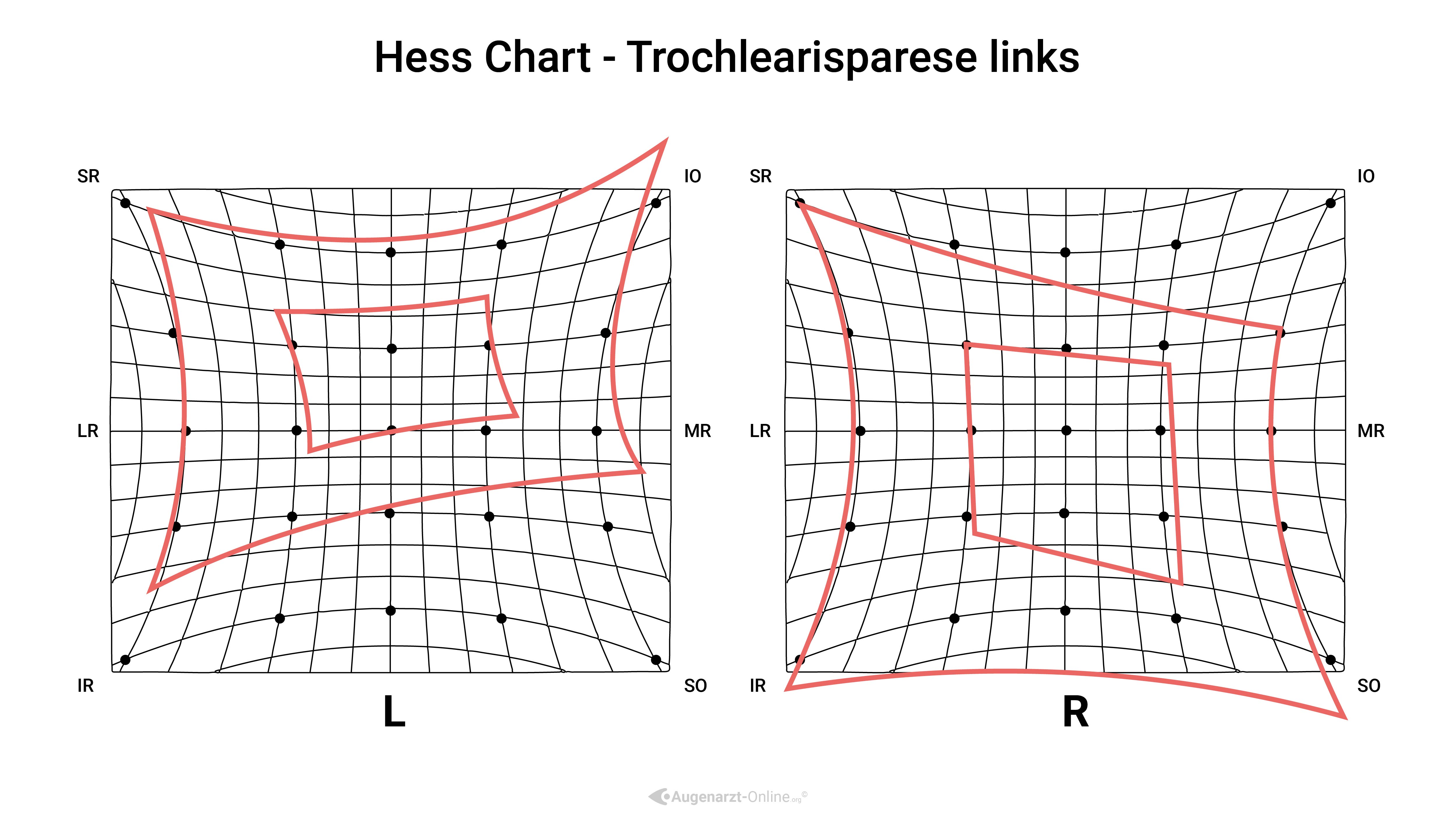 Hess Diagramm –Trochlearisparese links