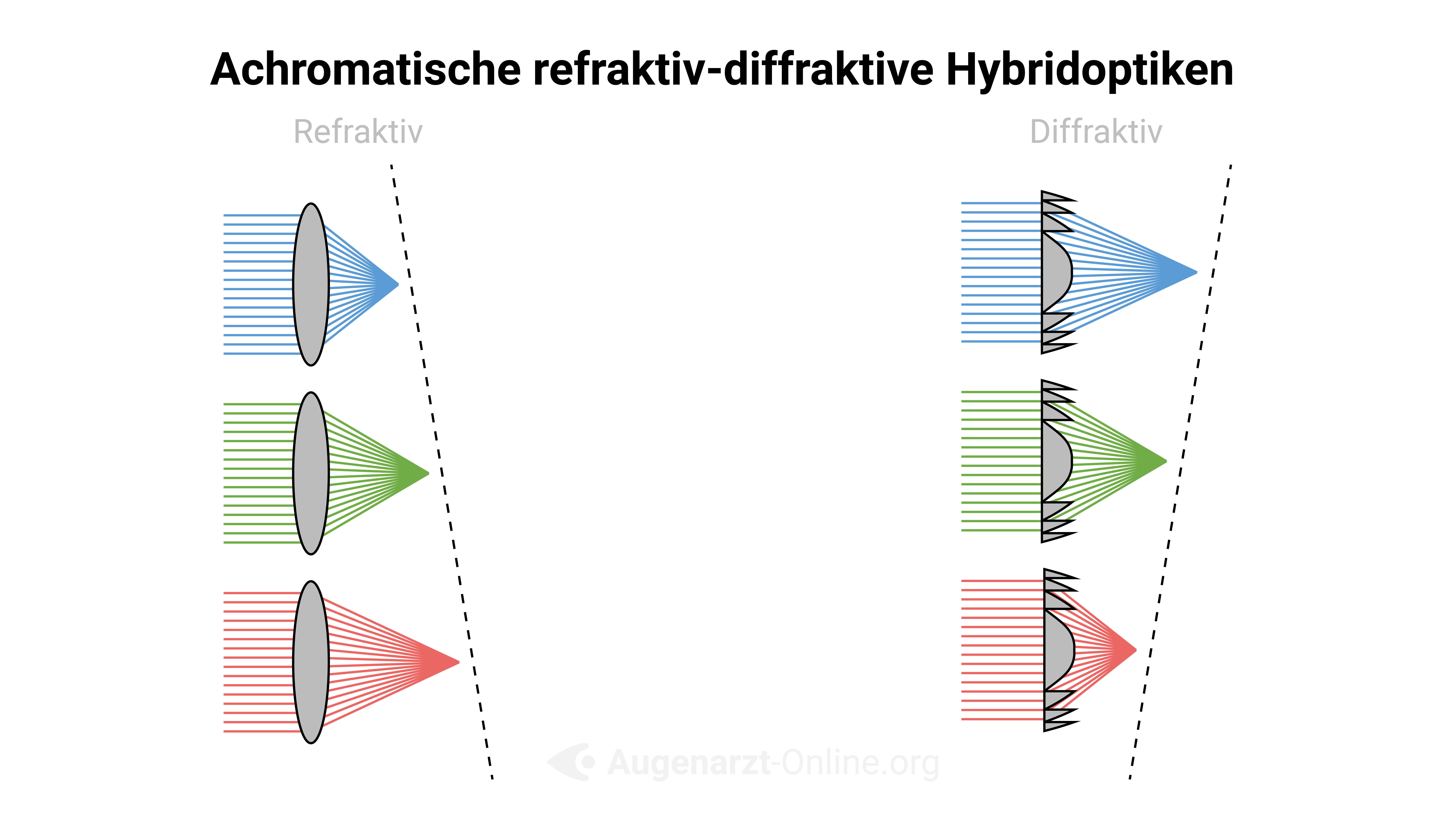 Achromatische Hybridoptik von Multifokallinsen