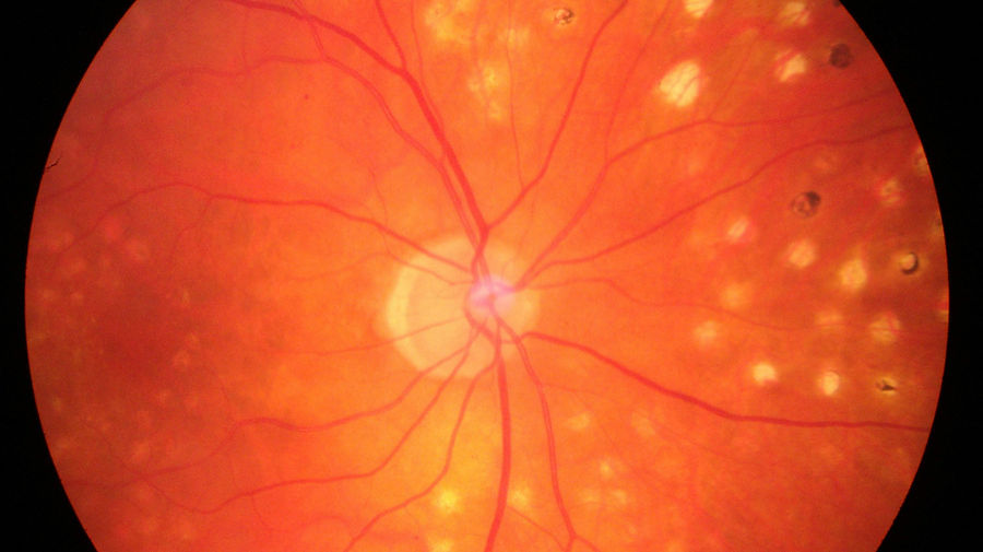 Augenhintergrund mit Laserherden (ALK).