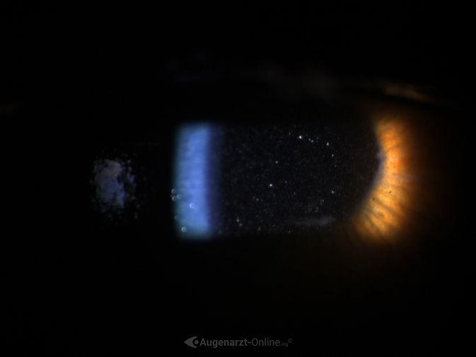 Spaltlampenfoto-Darstellung von Tyndall nach intravitreale Triaminjektion am rechten Auge. Der Tyndall-Effekt ist die Lichtstreuung an kleinen Schwebeteilchen (kolloidalen Teilchen) in transparenten Medien (Flüssigkeiten oder Gasen), wodurch ein Lichtstrahl von der Seite sichtbar wird.
