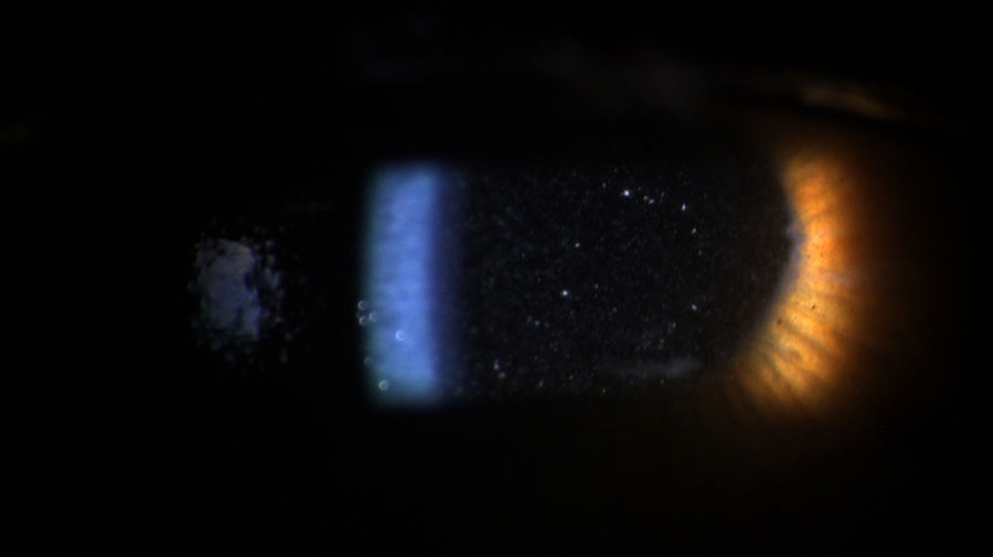 Spaltlampenfoto-Darstellung von Tyndall nach intravitreale Triaminjektion am rechten Auge. Der Tyndall-Effekt ist die Lichtstreuung an kleinen Schwebeteilchen (kolloidalen Teilchen) in transparenten Medien (Flüssigkeiten oder Gasen), wodurch ein Lichtstrahl von der Seite sichtbar wird. 