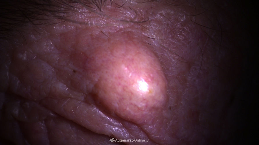 Chalazion oder Hagelkorn im Oberlid