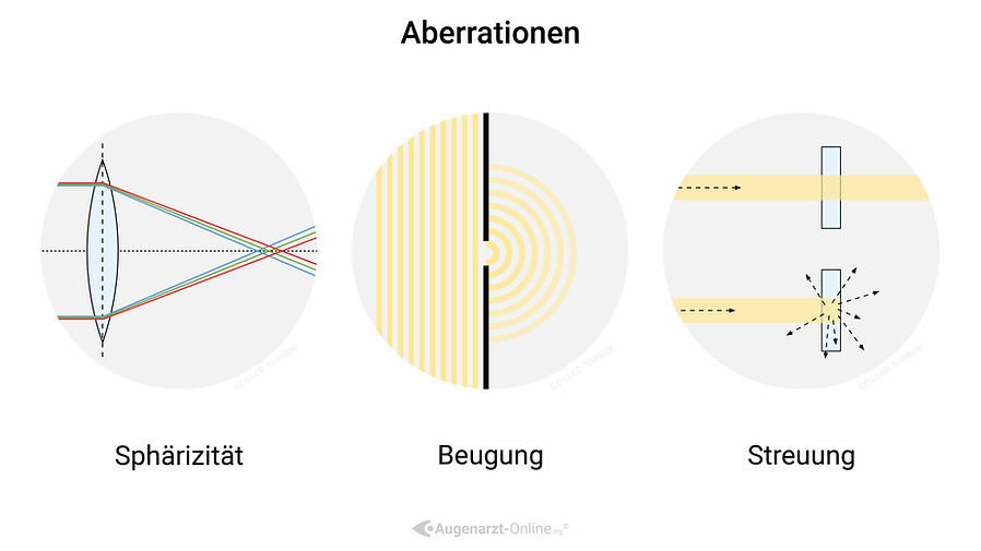 Spaltlampenfoto bei 2026-0601-backup_Illustrationen_Refraktionsfehler-33. 2026-0601-backup_Illustrationen_Refraktionsfehler-33 ist ein retinaler Befund mit möglicher Relevanz für Makula, Gefäße oder Papille.