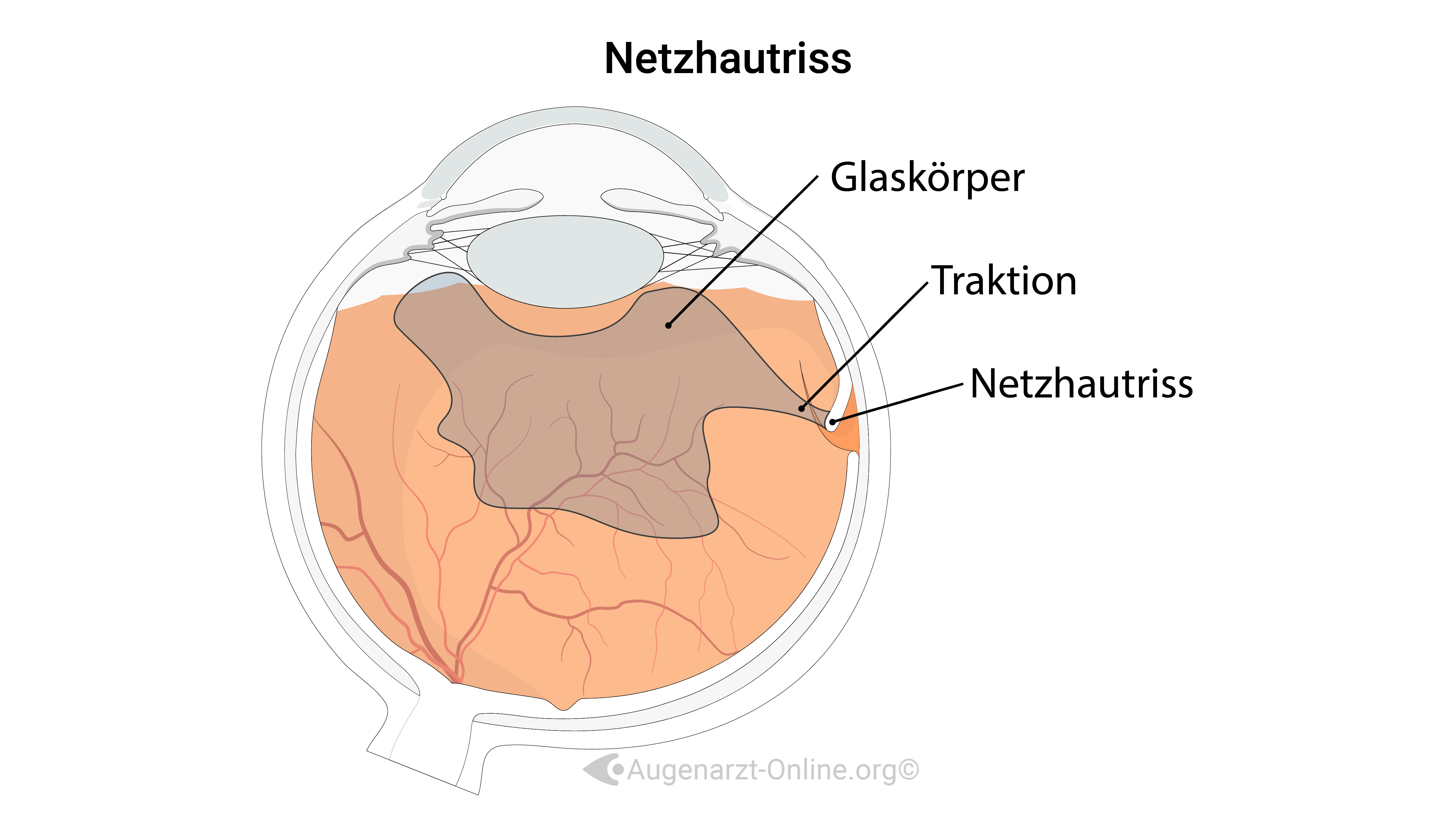 Traktiver Netzhautdefekt
