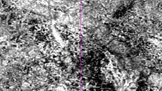 OCTA bei CNV Membran am rechten Auge. CNV Membran in der OCT Angiographie bei chorioialer Neovaskularisation bei feuchter Makuladegeneration.