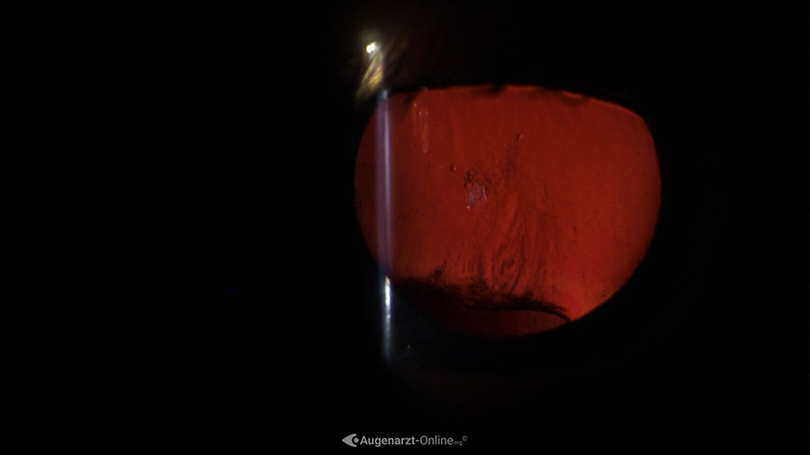 Inferiores Linsenkolobom im retrograden Licht.
