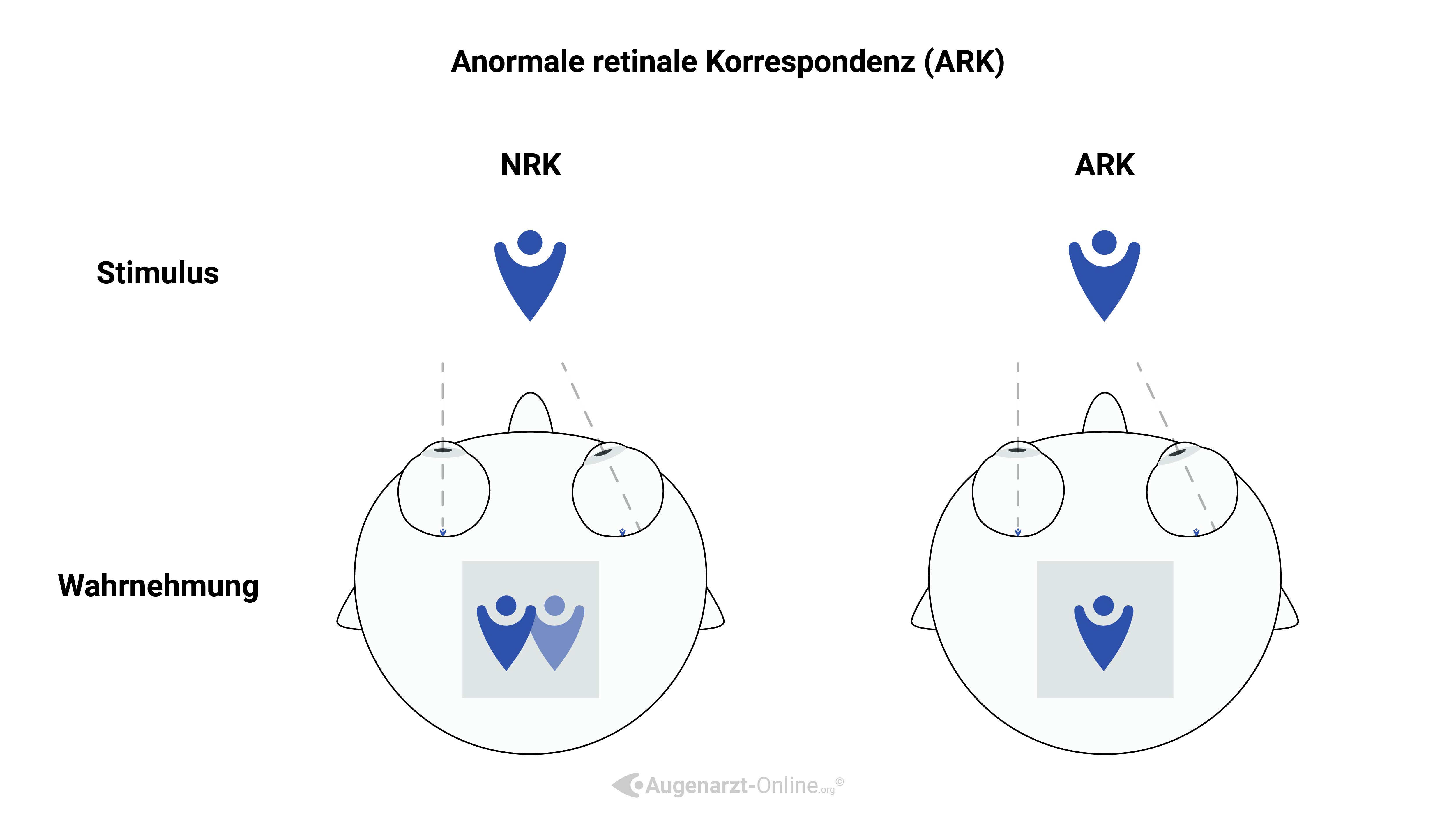 Anormale Retinale Korrespondenz