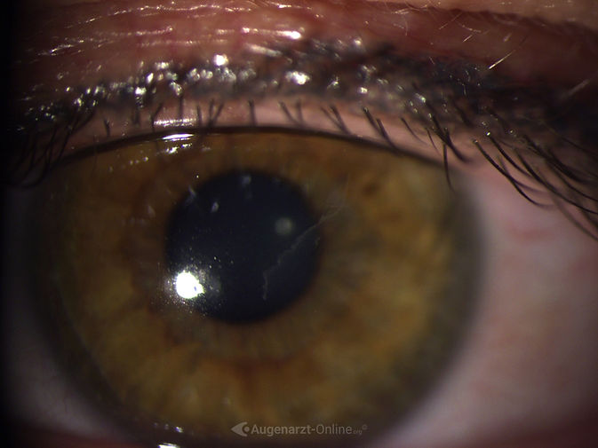 Spaltlampenfoto 2 zu Pseudodentrit nach Erosio cornea (rechts).