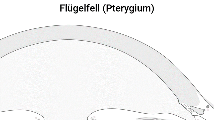 Pterygium - Erklärung Flügelfell Surfers Eye Animation.gif