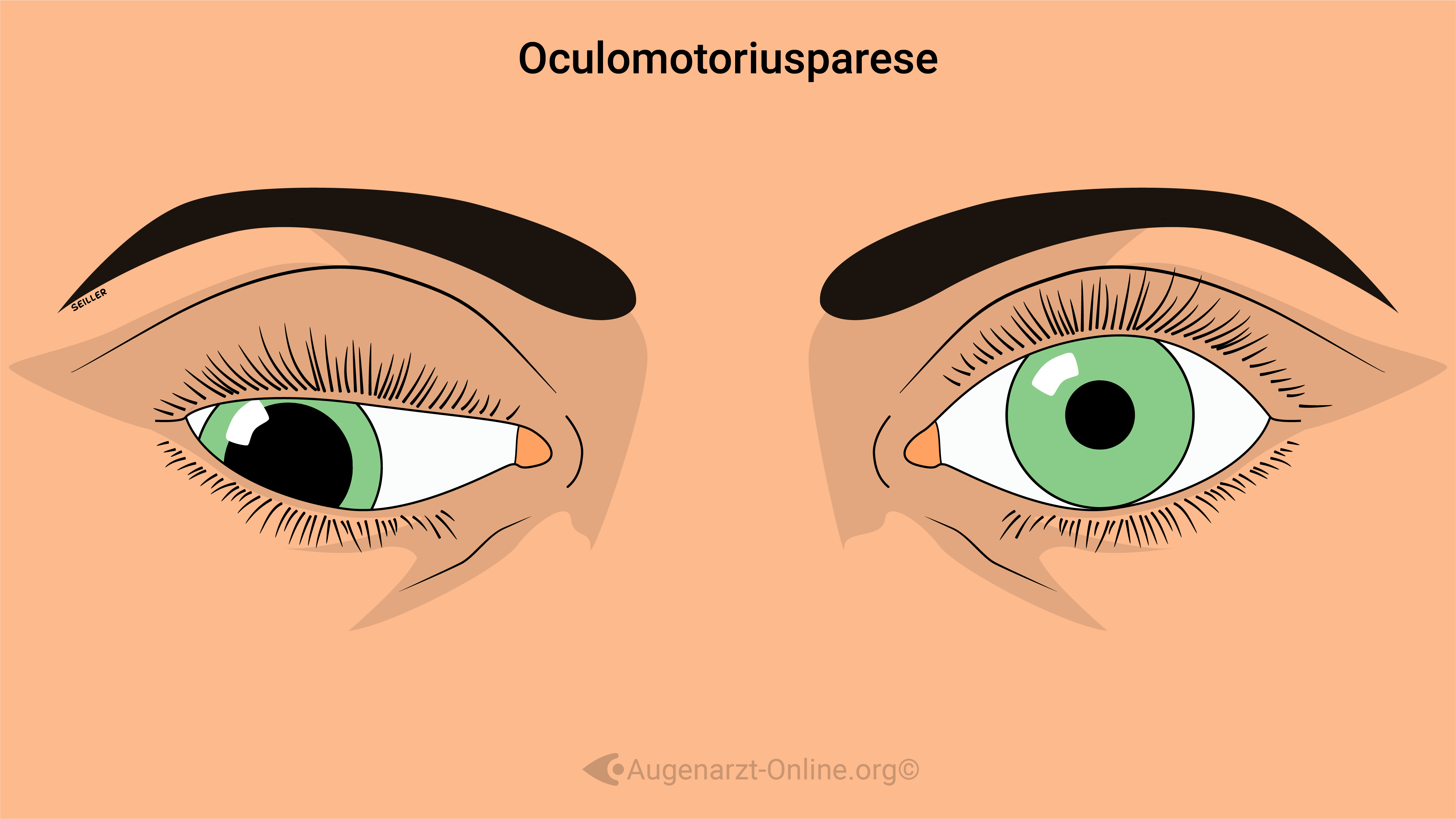 Oculomotoriusparese