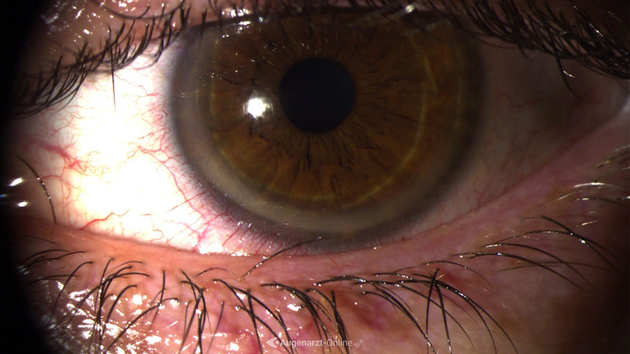 Fehlstellung einer Wimper am inferioren Augenlid bei Trichiasis.