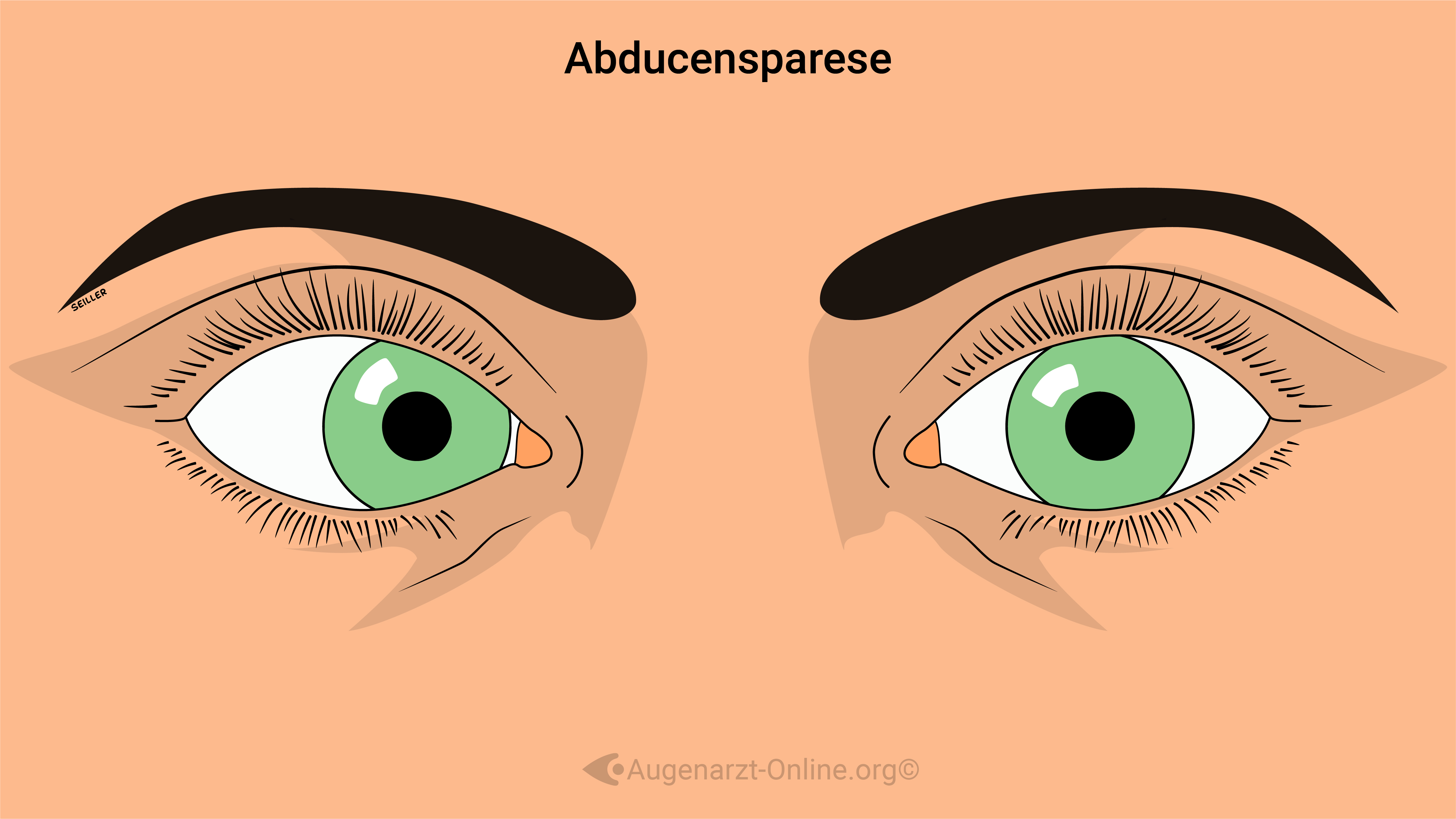 Abducensparese