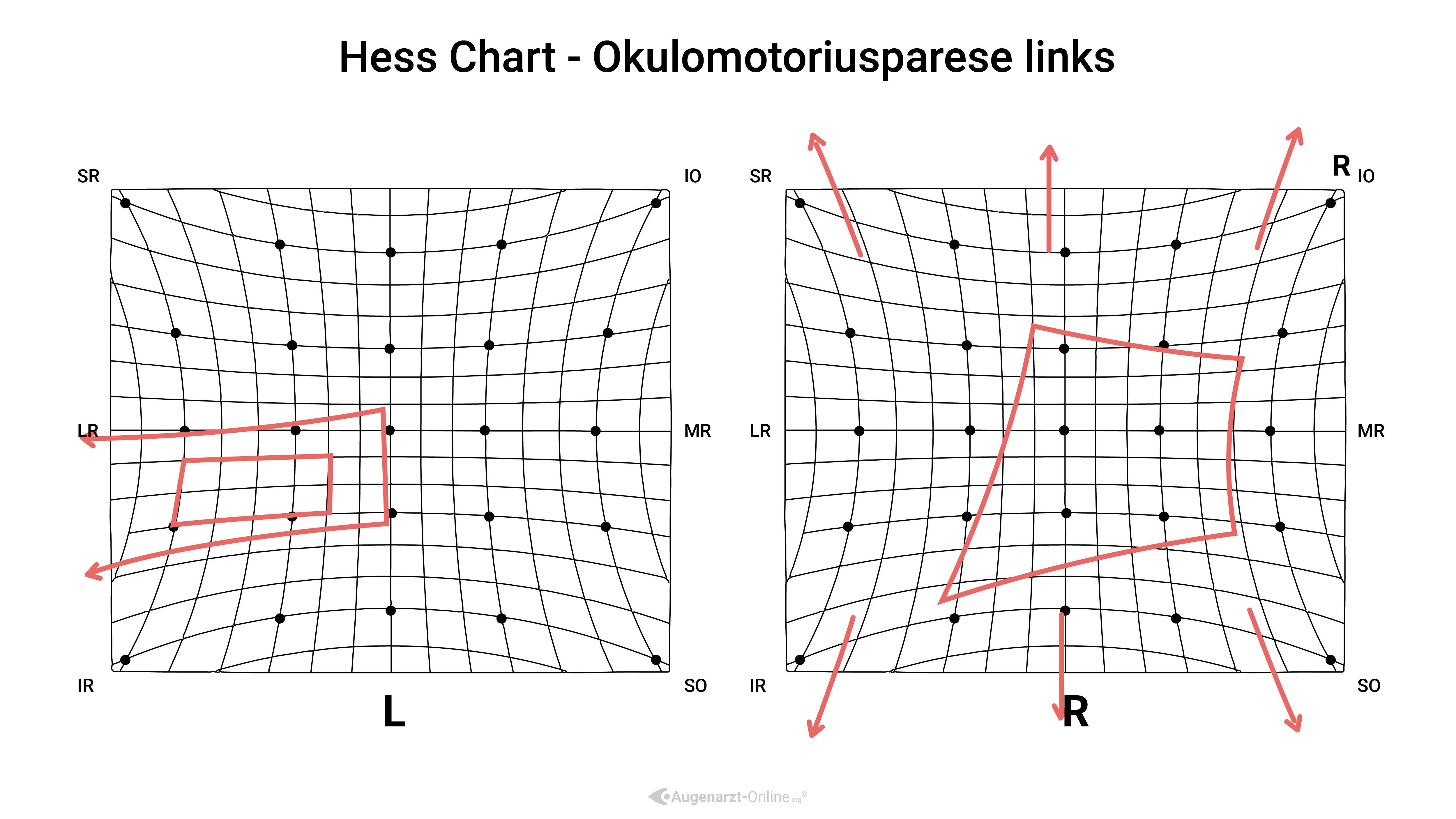 Hess Diagramm –Okulomotoriusparese links