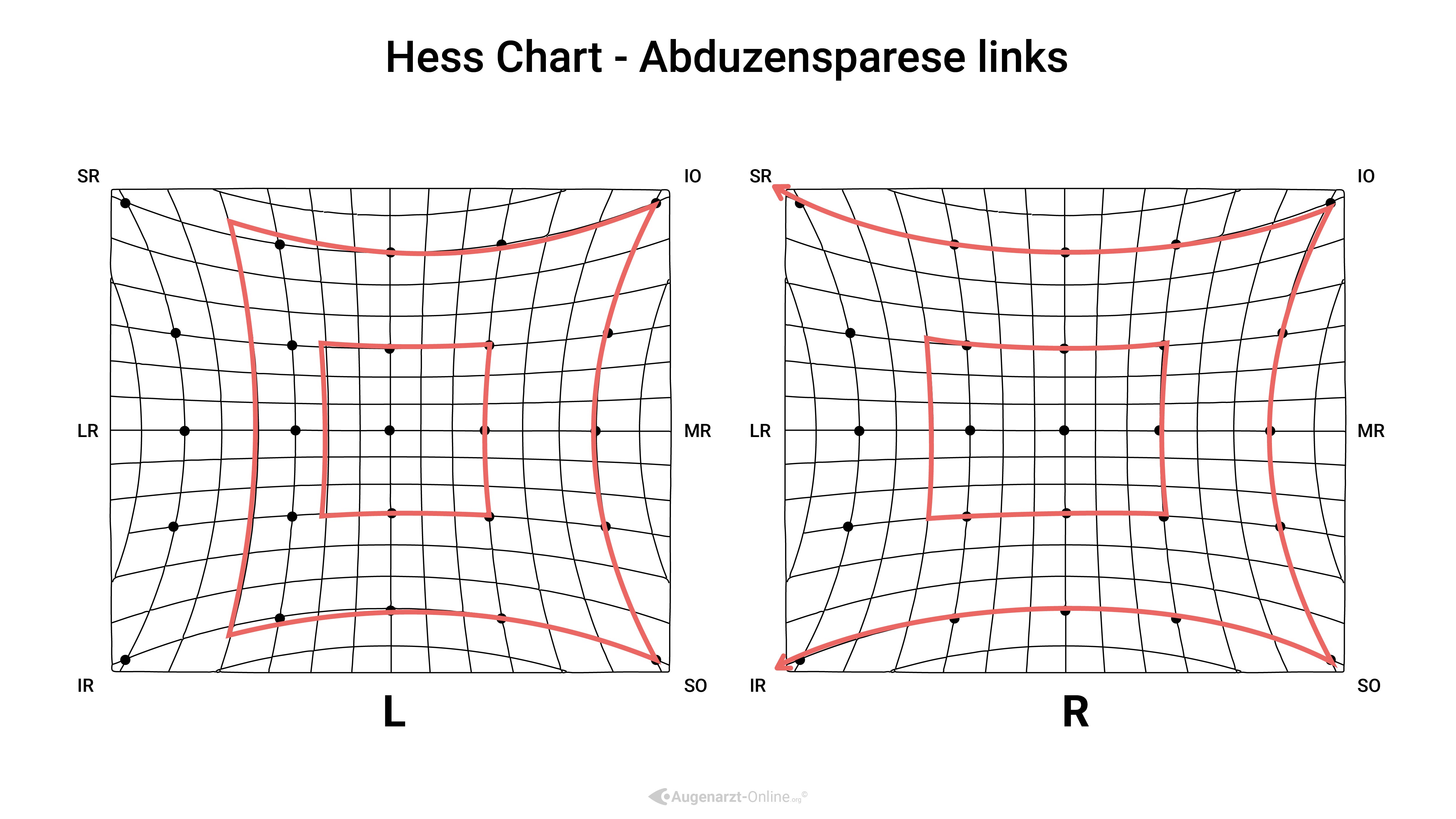 Hess Diagramm –Abduzensparese links