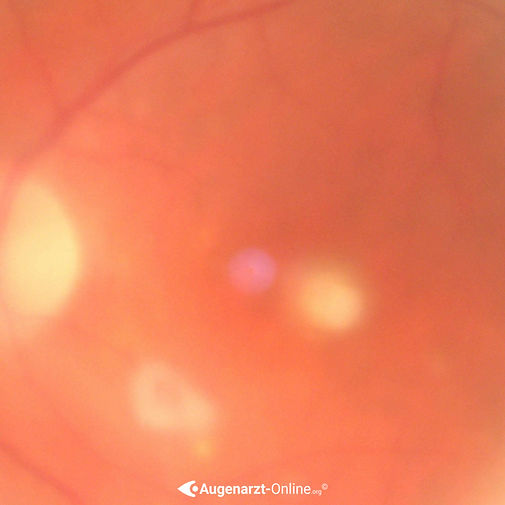Vergrößerte Darstellung des papillomakulären Bündels bei Candida Endophthalmitis. Aufgrund der Vitritis ist der Einblick getrübt. Es zeigen sich multiple weißliche Herde.