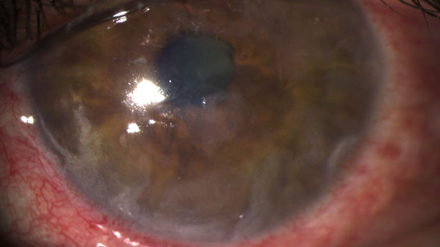 Spaltlampenfoto-Darstellung von Neurotrophe Keratopathie am linken Auge. Neurotrophe Keratopathie betrifft die Hornhaut; entscheidend sind Ätiologie, Tiefe des Befunds und rasche, zielgerichtete Therapie.