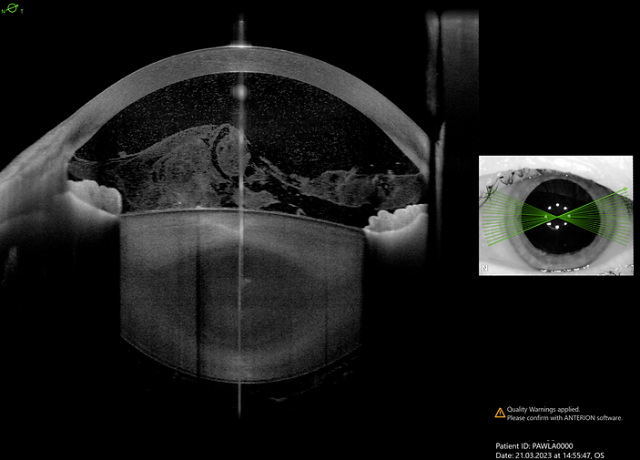 Befunddokumentation in Vorderabschnitt OCT: Uveitis anterior am linken Auge. Uveitis umfasst entzündliche Erkrankungen der Uvea mit möglicher Beteiligung angrenzender Strukturen. Für Diagnostik und Therapie sind Lokalisation, Verlaufsmuster und zugrunde liegende Systemerkrankungen wesentlich. Behandelt wird je nach Ursache mit antiinflammatorischen, immunmodulatorischen oder antiinfektiösen Strategien.