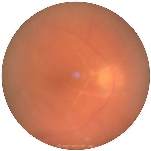 Vitritis