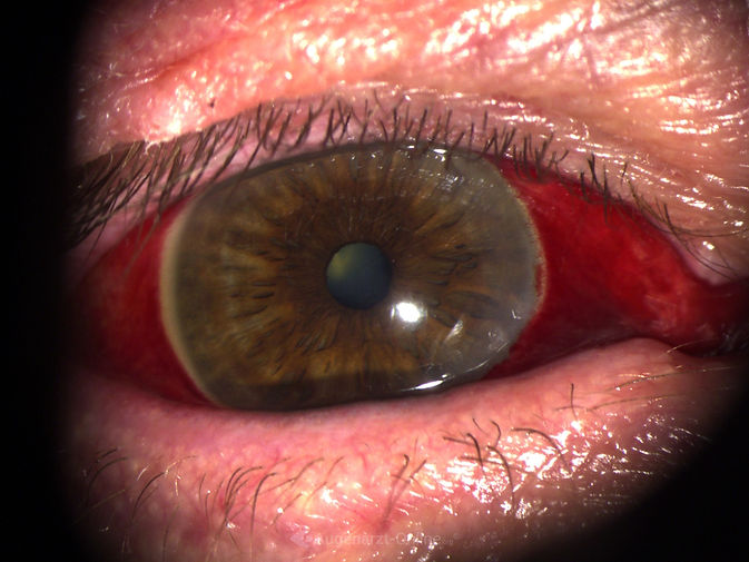 Befunddokumentation in Spaltlampenfoto: Hyposphagma am rechten Auge. Ein Hyposphagma ist eine subkonjunktivale Blutung in Folge eines geplatzten Äderchen.