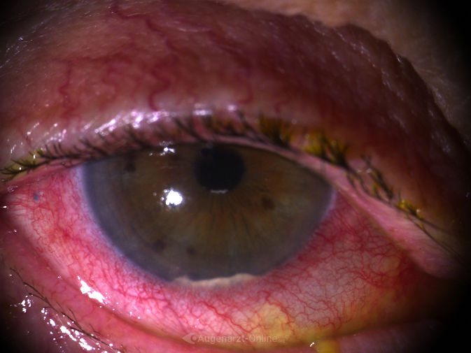 Tyndall nach intravitreale Triaminjektion (rechts).