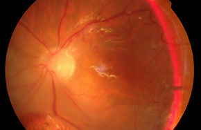 Ablatio retinae, Fundusfoto, Krankheiten, Netzhaut, Augenheilkunde, Ophthalmologie, linkes Auge, Ablatio, retinae, medizinisches Bild, Augenarzt, klinischer Befund
