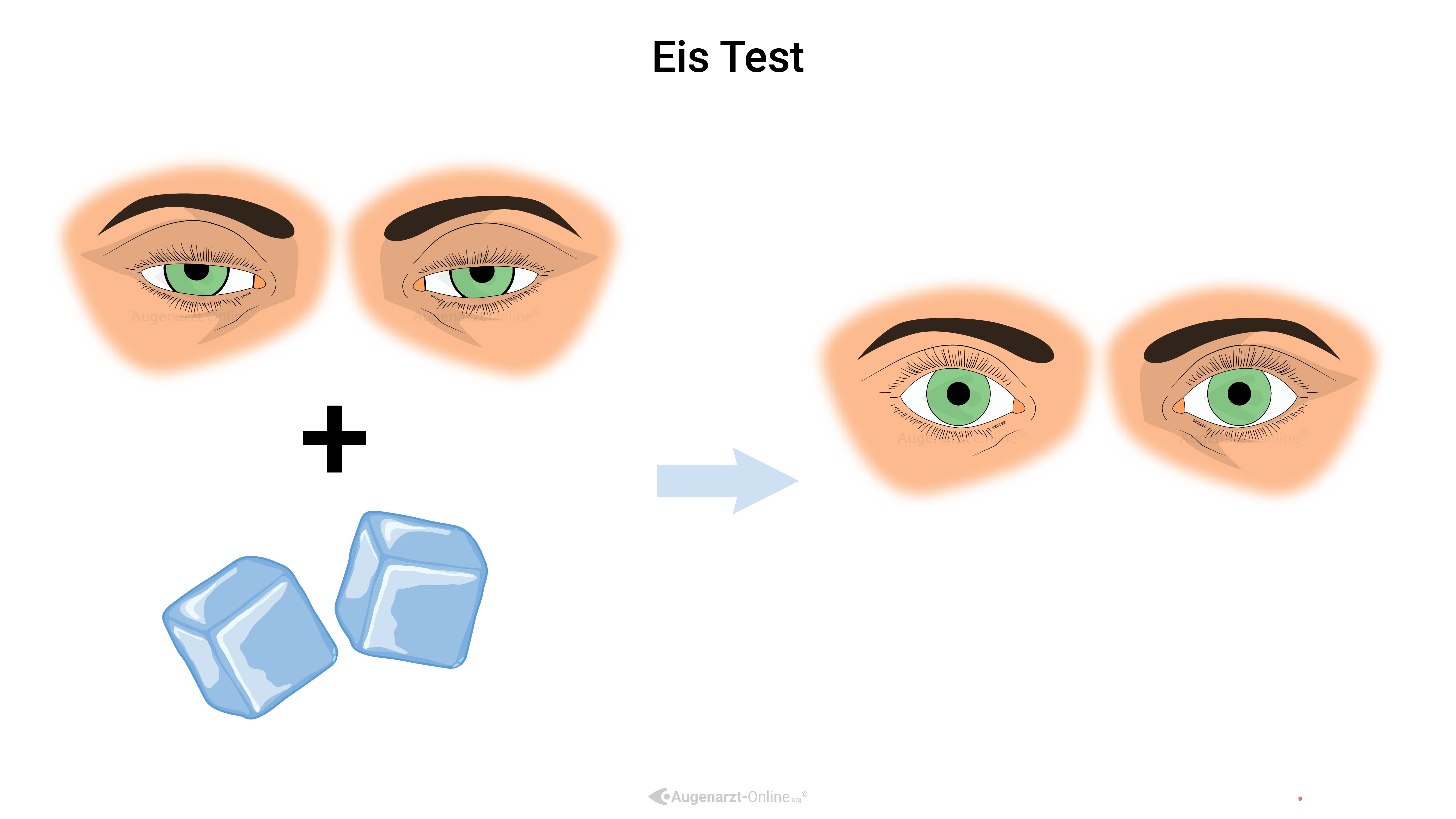 Eis est-Illustration-Myasthenia Gravis Fatigability Testing Ice Test.jpg