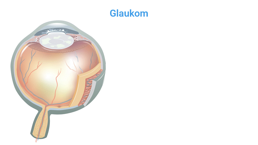 Glaukom - Erklärung Animation .gif