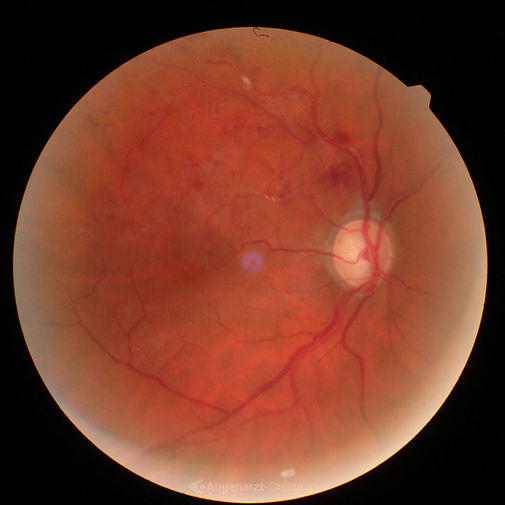 Astvenenthrombose sowie Plaque in Arterie am rechten Auge im Fundusfoto. Eine Astvenenthrombose ist ein retinaler Venenastverschluss mit venöser Stase, intraretinalen Blutungen und häufig Makulaödem. Die Behandlung umfasst je nach Befund intravitreale Anti-VEGF- oder Steroidtherapie sowie konsequente internistische Risikofaktorkontrolle.