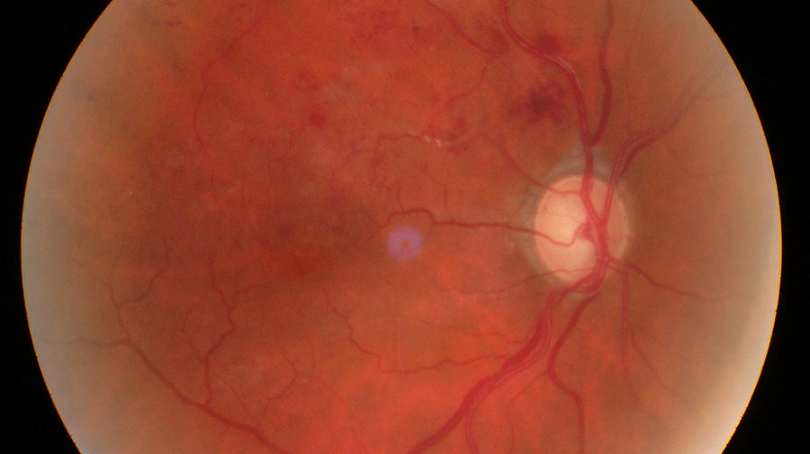 Astvenenthrombose sowie Plaque in Arterie am rechten Auge im Fundusfoto. Eine Astvenenthrombose ist ein retinaler Venenastverschluss mit venöser Stase, intraretinalen Blutungen und häufig Makulaödem. Die Behandlung umfasst je nach Befund intravitreale Anti-VEGF- oder Steroidtherapie sowie konsequente internistische Risikofaktorkontrolle.