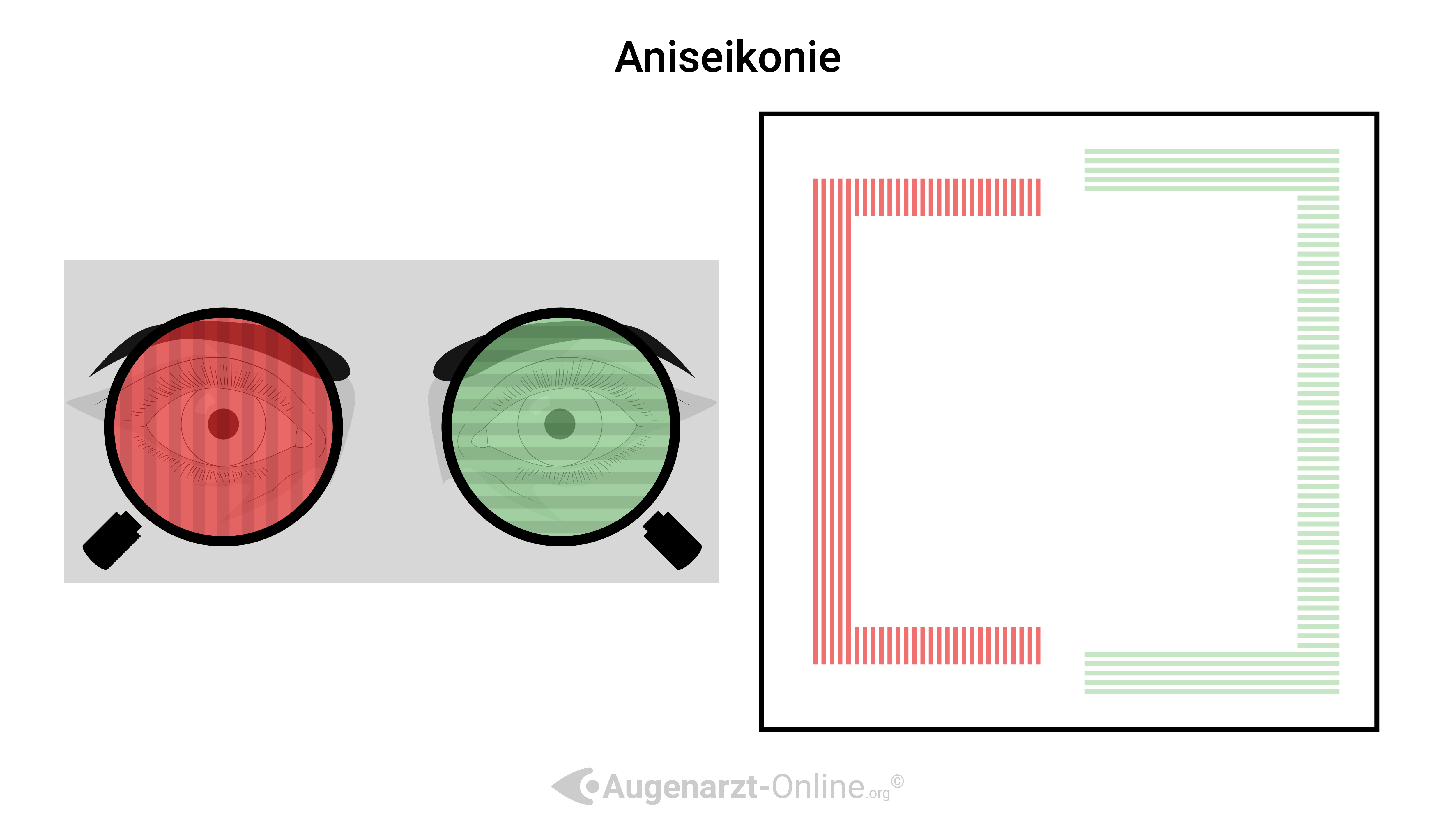 Aniseikonie im Hakentest