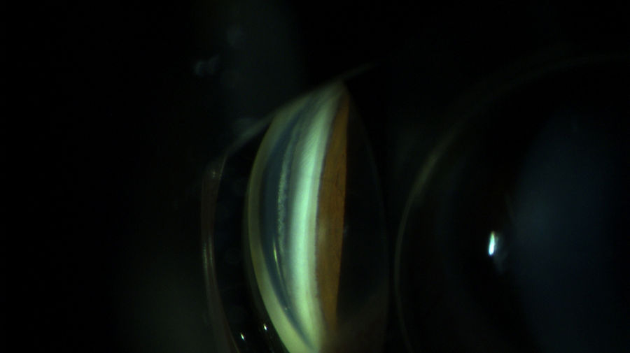 Spaltlampenfoto-Darstellung von Gonioskopie beidseits. Dreispiegelkontaktlglas zur Gonioskopie.