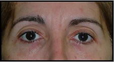 blefaroplastiadrgalosolano