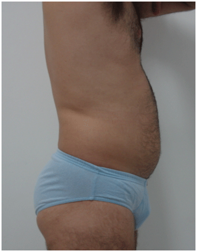 liposuccionmasculinadrgalosolano