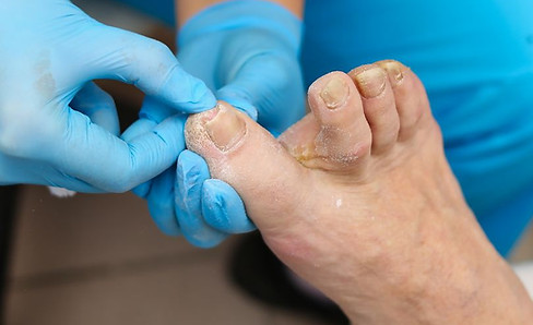 טיפול פטרת ציפורניים בנתניה