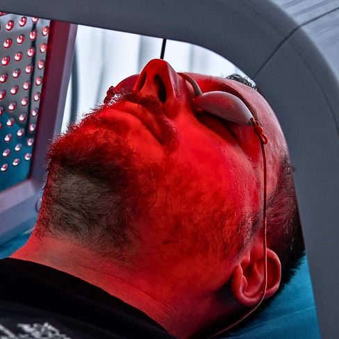 מיקרונידלינג לחידוש העור טיפול בפוסט אקנה בנתניה מרכז אסתטיקה OSTREA אוסטראה קוסמטיקה