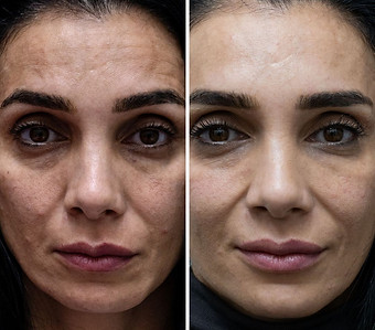 פרוטוקול משולש ביוסטימולטור טיפולי אסתטיקה - מתיחת פנים ללא ניתוח + טיפול בסנטר כפול והרמת