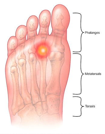 metatarsalgia.jpg