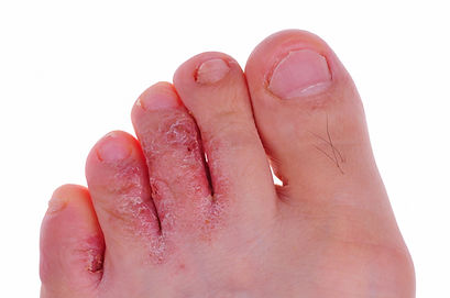 athlete's foot.jpg