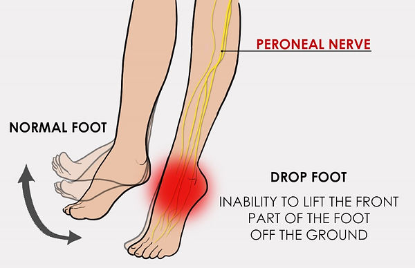 footdrop-e1464906348459-960x621.jpg