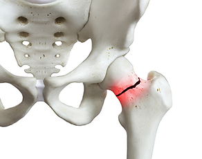 Fractured hip and wrist.png