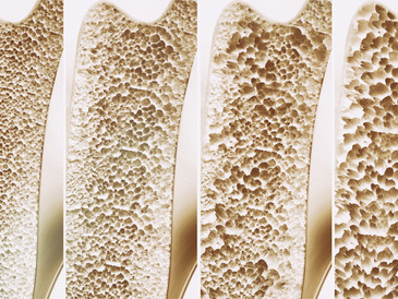 Osteoporosis 4 stages