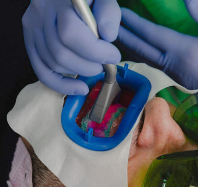 BLANQUEAMIENTO DENTAL CON LÁSER DE DIODO